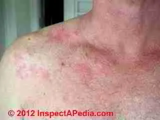 mold-allergy